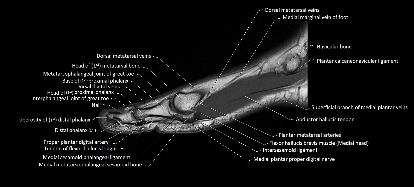 MRI foot sagittal labelled cross sectional anatomy image  4.webp